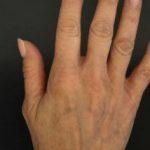 Profhilo 1 month after Profhilo second treatment