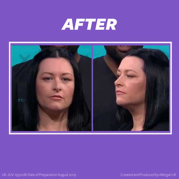 Dermal Fillers Before and after