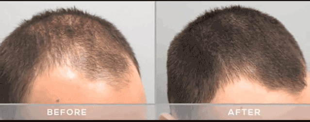 Male Pattern Baldness