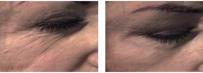 Polynucleotides vs Profhilo: Discover the Best Choice for Your Skin Polynucleotides