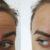 botox