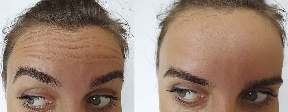 Woman forehead wrinkles before and after treatment