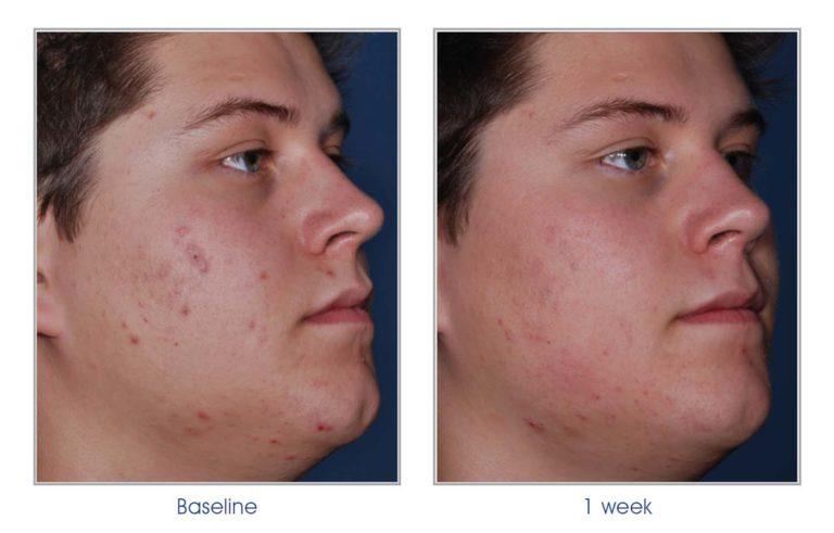Acne pitting treatment Acne pitting treatment