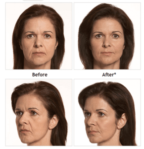Juvederm-before-and-after