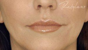 Lips after filler