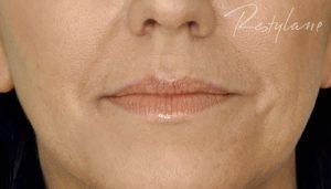 Lips before filler