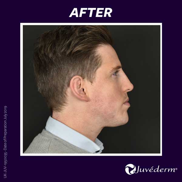 Dermal Fillers After Allergan treatment for men