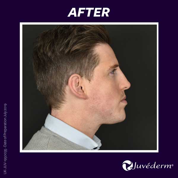 After Allergan treatment for men