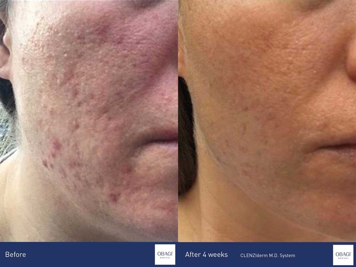 ACNE VULGARIS