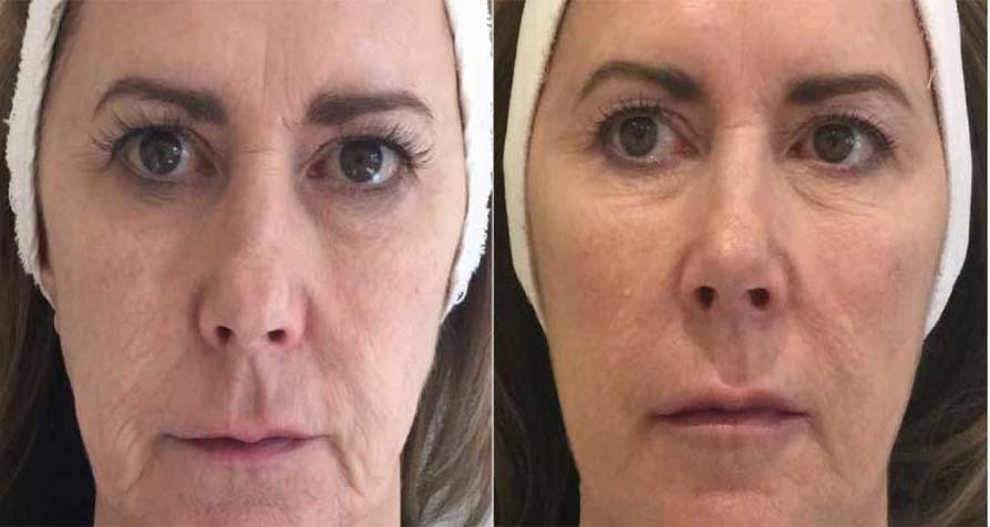 A Game Changer for Cosmetic Treatments! Profhilo