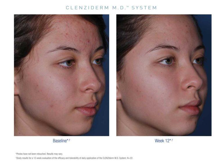 CLEANZIderm before and after treatment Girl