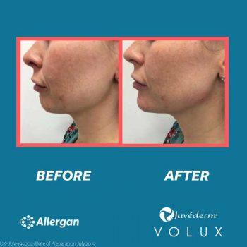 The New 7 Point Face Lift - Somerset Cosmetic Clinic