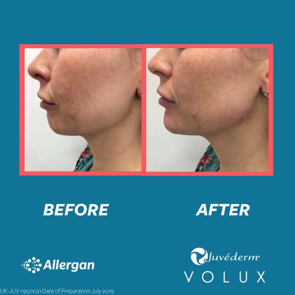 Volux before and after