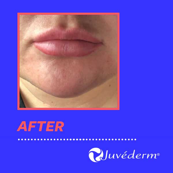 Dermal Fillers Juvederm after