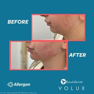 Volux allergan before and after jaw