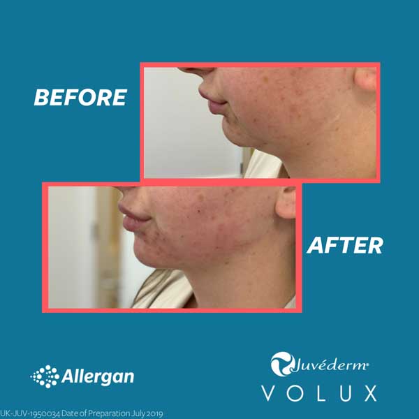 Dermal Fillers Volux allergan before and after jaw
