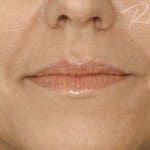 before-dermal-fillers-lips