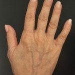 Hand before Profhilo injections