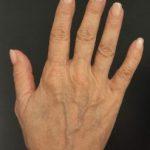Profhilo Hand before Profhilo injections