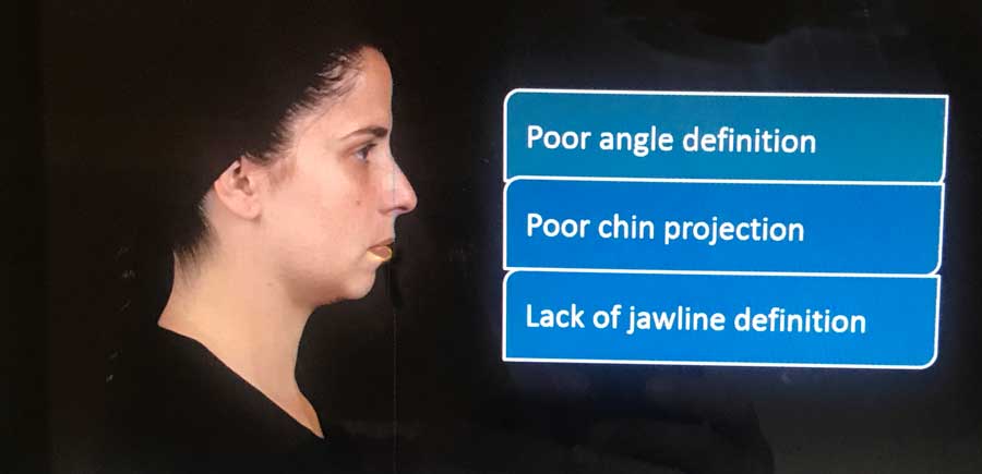 The New 7 Point Face Lift 7 Point lift corrections