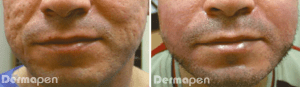 dermapen-before-and-after