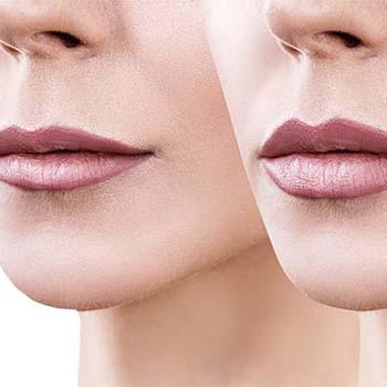 Lip fillers