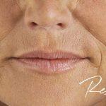 Nasolabial Folds Before