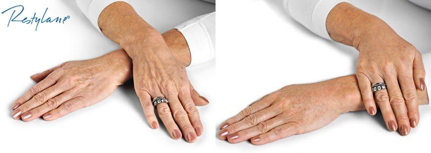 restylane_hands