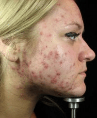 Acne and pitting is treatable – no one needs to suffer in silence anymore sandra-before