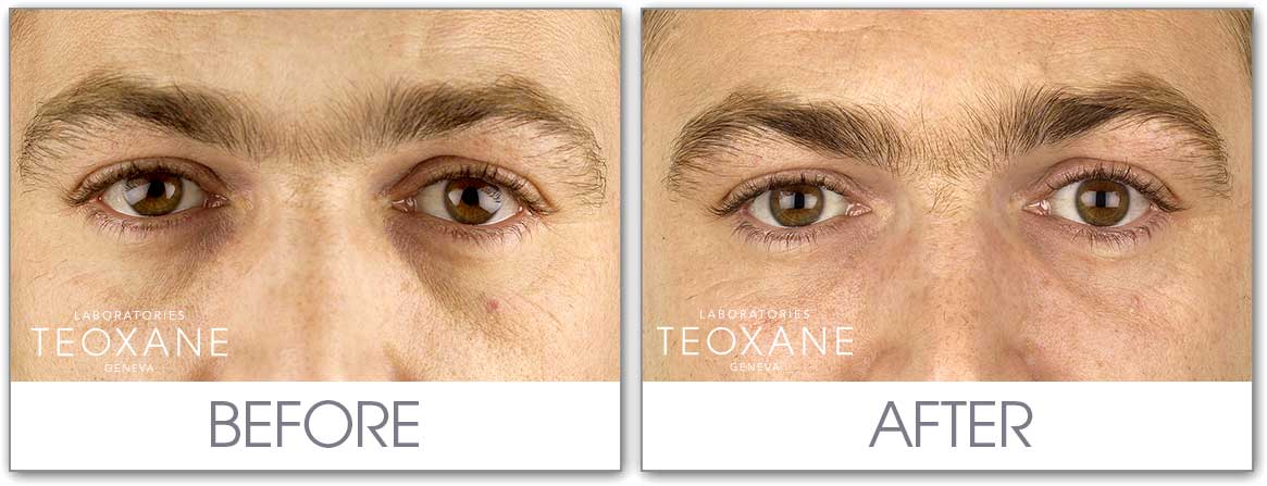 The forgotten areas … Dermal fillers for men